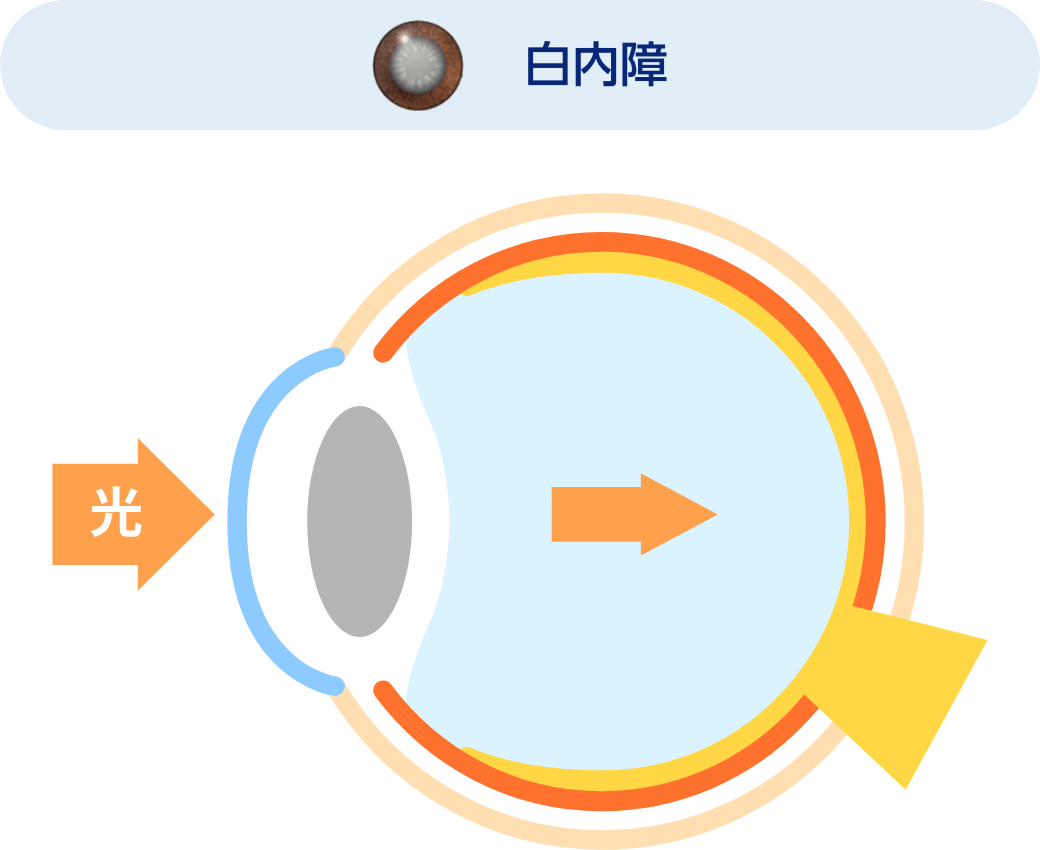 白内障