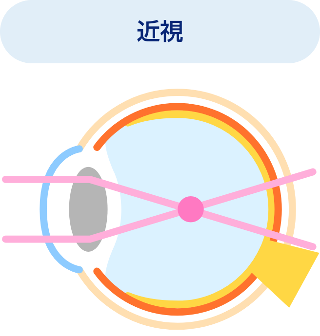近視
