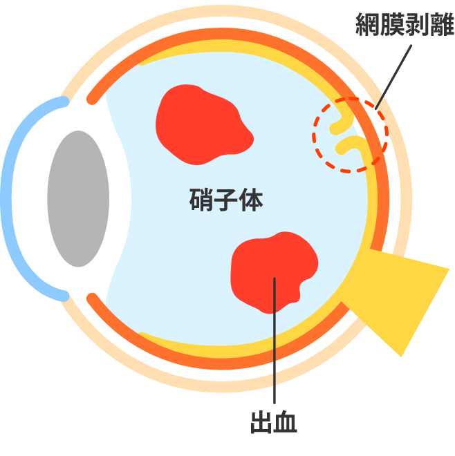 糖尿病網膜症とは